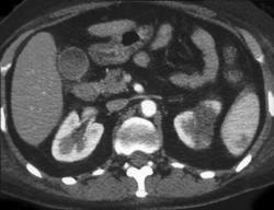 Renal Infarcts - CTisus CT Scan