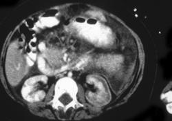 Renal Infarction - CTisus CT Scan