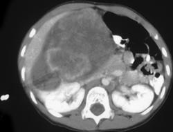 Rhabdoid Renal Tumor - CTisus CT Scan