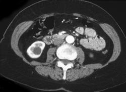 Renal Cyst - CTisus CT Scan