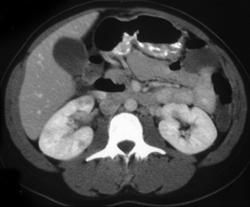 Acute Pyelonephritis - CTisus CT Scan