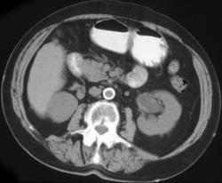 Transitional Cell Carcinoma (lt Kidney) - CTisus CT Scan