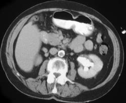 Transitional Cell Carcinoma (delayed Scans) - CTisus CT Scan