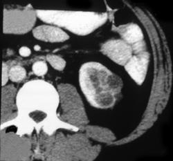 Cystic Renal Cell Carcinoma - CTisus CT Scan