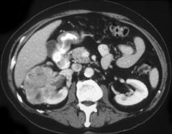 Synchronous Renal Cell Carcinomas - CTisus CT Scan