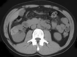 Atypical Renal Cyst - CTisus CT Scan