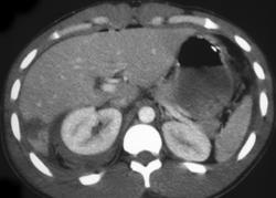 Renal and Liver Lacerations - CTisus CT Scan