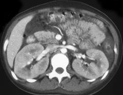 AIDS Nephropathy - CTisus CT Scan