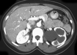 Parapelvic Cysts and Hydronephrosis - CTisus CT Scan