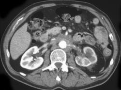 Retroperitoneal Fibrosis - CTisus CT Scan