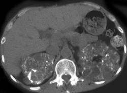 Polycystic Kidney Disease - CTisus CT Scan