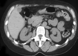 Renal Cell-easy to Miss on Non-contrast CT (see Prior Case!) - CTisus CT Scan