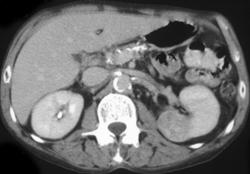 Renal Cell Carcinoma - CTisus CT Scan