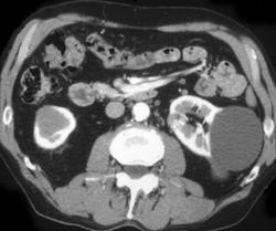 Subtle 1 Cm Renal Cell Carcinoma - CTisus CT Scan