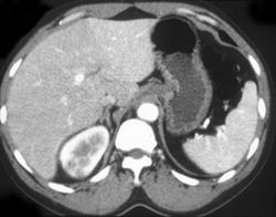 Acute Pyelonephritis - CTisus CT Scan