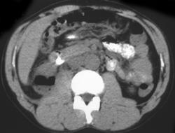 Abscess Near Right Kidney - CTisus CT Scan