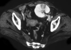 Pyelonephritis in Transplant Kidney - CTisus CT Scan