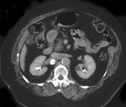 Renal Artery Aneurysm - CTisus CT Scan