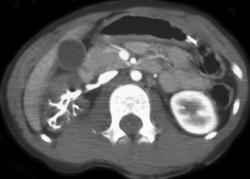 Infarcted Kidney - CTisus CT Scan