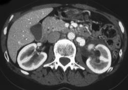 Huge Left Gonadal Vein - CTisus CT Scan