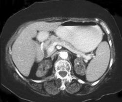 End Stage Renal Disease - CTisus CT Scan