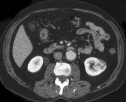 Renal Cell Carcinoma - CTisus CT Scan