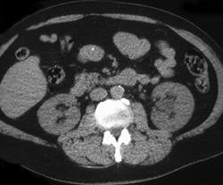 Obstructing Stone in Ureter - CTisus CT Scan