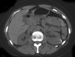 Calcified Renal Cyst - CTisus CT Scan