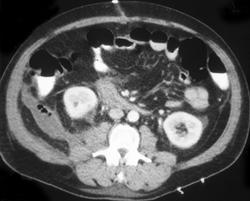 Inflammation in Para-renal Space - CTisus CT Scan