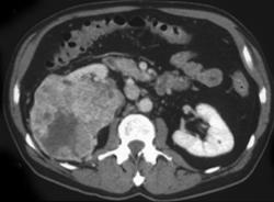 Renal Cell Carcinoma Invades Renal Vein and IVC - CTisus CT Scan