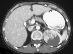 Mesoblastic Nephroma - CTisus CT Scan