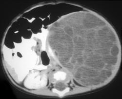 Multilocular Cyst - CTisus CT Scan