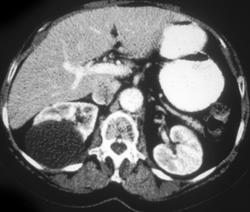 Renal Cyst - CTisus CT Scan