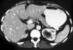 Acute Pyelonephritis - CTisus CT Scan