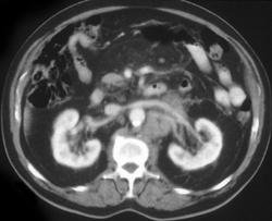 Adenopathy in Patient With Prostate Cancer - CTisus CT Scan