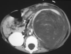 Wilms Tumor - CTisus CT Scan