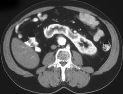 Horseshoe Kidney - CTisus CT Scan