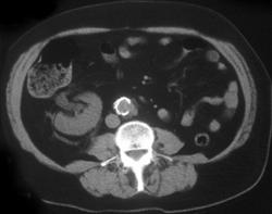 Malrotated Kidney With Stone That Simulated Appendicolith on Plain Films - CTisus CT Scan