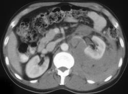 Perirenal Lymphoma - CTisus CT Scan