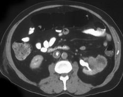 Transitional Cell Carcinoma - CTisus CT Scan