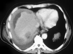 Carcinomatosis Due to Renal Cell Carcinoma - CTisus CT Scan