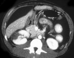 Renal Laceration - CTisus CT Scan