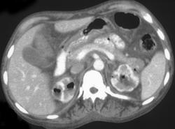 Emphysematous Pyelitis - CTisus CT Scan