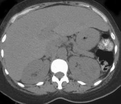 Renal Abscess - CTisus CT Scan