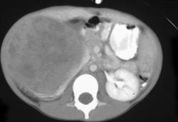 Wilms Tumor - CTisus CT Scan