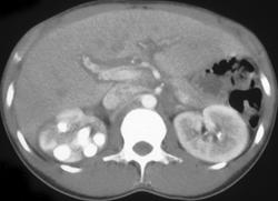 Acute and Chronic Pyelonephritis - CTisus CT Scan