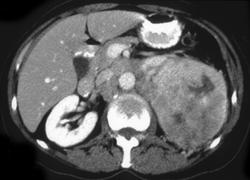 Renal Cell Carcinoma Metastatic to Mediastinum - CTisus CT Scan