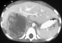 Primary Renal Sarcoma - CTisus CT Scan