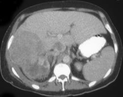 Renal Cell Carcinoma Invades Liver and IVC - CTisus CT Scan