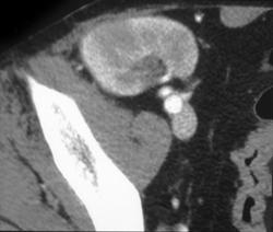 Pyelonephritis in Renal Transplant - CTisus CT Scan